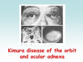 Kimura disease of the orbit
and ocular adnexa
 