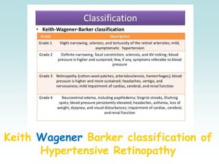 Keith Wagener Barker classification of
Hypertensive Retinopathy
 