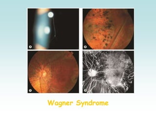 Wagner Syndrome
 