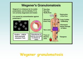 Wegener granulomatosis
 