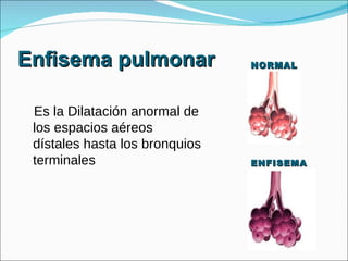 Enfisema pulmonar Es la Dilatación anormal de los espacios aéreos dístales hasta los bronquios terminales NORMAL ENFISEMA 