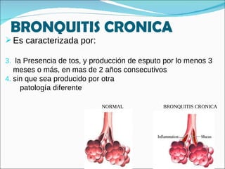 BRONQUITIS CRONICA Es caracterizada por: la Presencia de tos, y producción de esputo por lo menos 3 meses o más, en mas de 2 años consecutivos sin que sea producido por otra  patología diferente  NORMAL   BRONQUITIS CRONICA 
