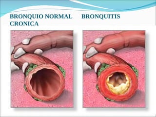 BRONQUIO NORMAL  BRONQUITIS CRONICA 