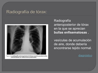 Radiografía
    anteroposterior de tórax
    en la que se aprecian
    bullas enfisematosas .

   vesículas de acumulación
    de aire, donde debería
    encontrarse tejido normal.

                    diagnóstico
 