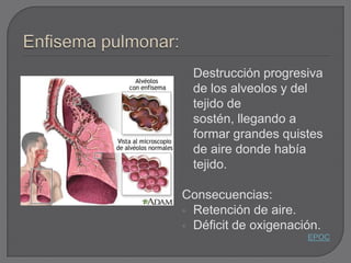 Destrucción progresiva
  de los alveolos y del
  tejido de
  sostén, llegando a
  formar grandes quistes
  de aire donde había
  tejido.

Consecuencias:
 Retención de aire.
 Déficit de oxigenación.
                      EPOC
 