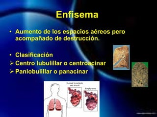 Enfisema  Aumento de los espacios aéreos pero acompañado de destrucción.  Clasificación Centro lubulillar o centroacinar Panlobulillar o panacinar 