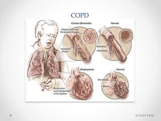 COPD
4/15/2013 32
 