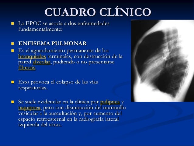 El medio público de la várice varicosa
