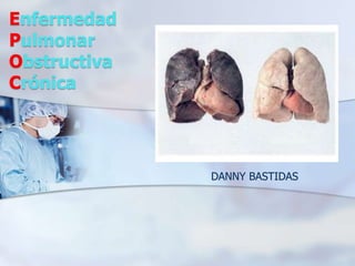 Enfermedad
Pulmonar
Obstructiva
Crónica

DANNY BASTIDAS

 