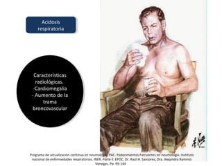 Acidosis
respiratoria
Acidosis
respiratoria
Características
radiológicas.
-Cardiomegalia
- Aumento de la
trama
broncovascular
Características
radiológicas.
-Cardiomegalia
- Aumento de la
trama
broncovascular
Programa de actualización continua en neumología. PAC. Padecimientos frecuentes en neumología. Instituto
nacional de enfermedades respiratorias. INER. Parte ll. EPOC. Dr. Raúl H. Sansores, Dra. Alejandra Ramírez
Venegas. Pp. 99-144
 