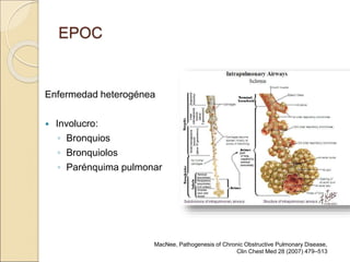 EPOC
Enfermedad heterogénea
 Involucro:
◦ Bronquios
◦ Bronquiolos
◦ Parénquima pulmonar
MacNee, Pathogenesis of Chronic Obstructive Pulmonary Disease,
Clin Chest Med 28 (2007) 479–513
 