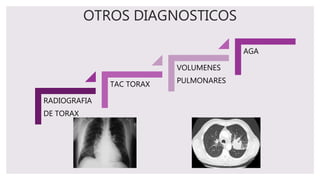 OTROS DIAGNOSTICOS
RADIOGRAFIA
DE TORAX
TAC TORAX
VOLUMENES
PULMONARES
AGA
 