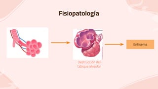 Fisiopatología
Destrucción del
tabique alveolar
Enfisema
 