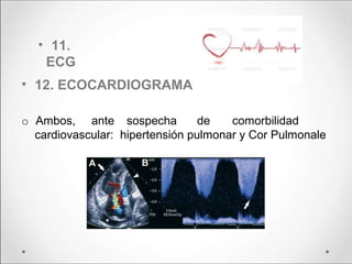 • 11.
ECG
• 12. ECOCARDIOGRAMA
o Ambos, ante sospecha de comorbilidad
cardiovascular: hipertensión pulmonar y Cor Pulmonale
 