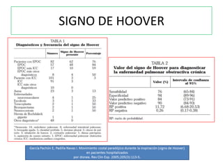 SIGNO DE HOOVER
 