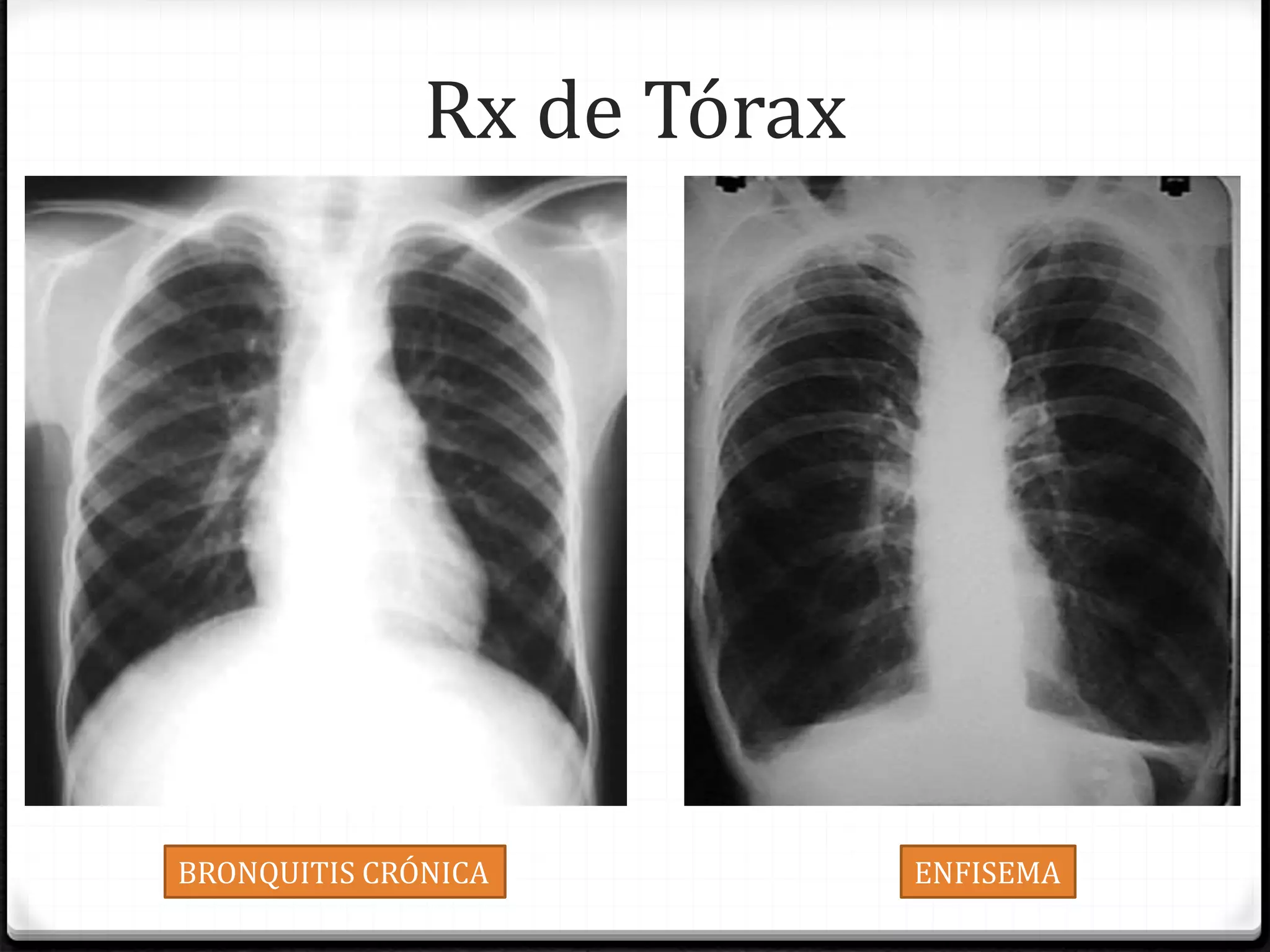 Rx de Tórax
BRONQUITIS CRÓNICA ENFISEMA
 