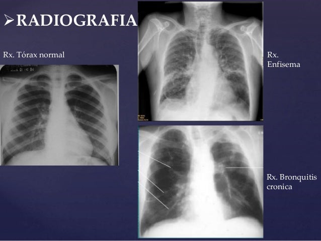 Epoc Tema Fisiopatologia epoc-tema-fisiopatologia