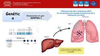Mutaciones en gen
SERPINA-1.
Genétic
o
Deficiencia de alfa-1 antitripsina (AAT)
Es una proteína que protege los pulmones de la
inflamación y el daño
 
