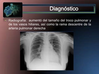 • Radiografía: aumentó del tamaño del troco pulmonar y
de los vasos hiliares, así como la rama descentre de la
arteria pulmonar derecha

 