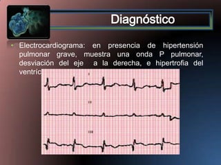 • Electrocardiograma: en presencia de hipertensión
pulmonar grave, muestra una onda P pulmonar,
desviación del eje a la derecha, e hipertrofia del
ventrículo derecho

 