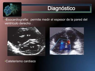 •Ecocardiografia: permite medir el espesor de la pared del
ventrículo derecho .

•Cateterismo cardiaco

 