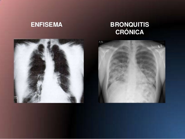 Epoc y cor pulmonale