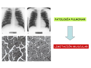 PATOLOGÍA PULMONAR
LIMITACIÓN MUSCULAR
 