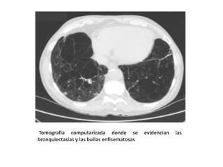 Tomografia computarizada donde se evidencian las
bronquiectasias y las bullas enfisematosas.
 