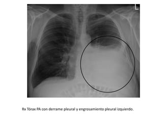 Rx Tórax PA con derrame pleural y engrosamiento pleural izquierdo.
 