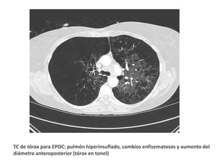 TC de tórax para EPOC: pulmón hiperinsuflado, cambios enfisematosos y aumento del
diámetro anteroposterior (tórax en tonel)
 