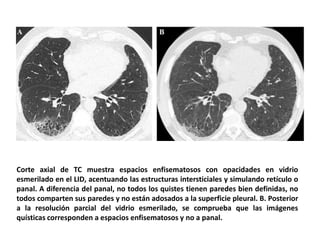 Corte axial de TC muestra espacios enfisematosos con opacidades en vidrio
esmerilado en el LID, acentuando las estructuras intersticiales y simulando retículo o
panal. A diferencia del panal, no todos los quistes tienen paredes bien definidas, no
todos comparten sus paredes y no están adosados a la superficie pleural. B. Posterior
a la resolución parcial del vidrio esmerilado, se comprueba que las imágenes
quísticas corresponden a espacios enfisematosos y no a panal.
 
