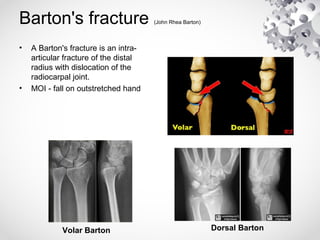 eponymousfractures-160228213145.pdf