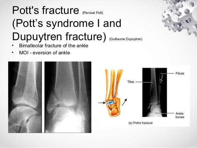 pott s fracture