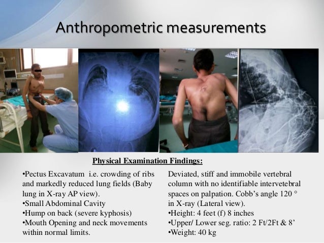 Severe Kyphoscoliosis with Inguinal Swelling excision
