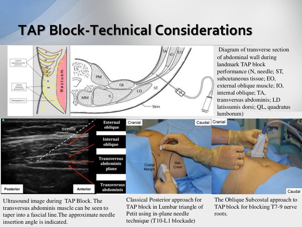 Severe Kyphoscoliosis with Inguinal Swelling excision underUSG guided…