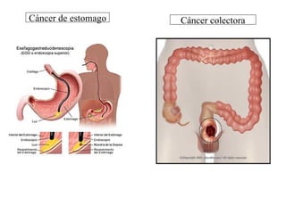 Cáncer de estomago Cáncer colectora 