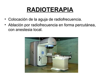 RADIOTERAPIA Colocación de la aguja de radiofrecuencia. Ablación por radiofrecuencia en forma percutánea, con anestesia local. 