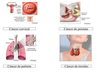 Cáncer cervical Cáncer de próstata Cáncer de pulmón Cáncer de tiroides 