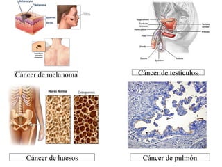 Cáncer de melanoma Cáncer de testículos Cáncer de huesos Cáncer de pulmón 