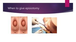 When to give episiotomy
 