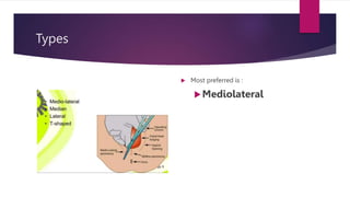 Types
 Most preferred is :
Mediolateral
 