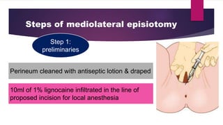 Steps of mediolateral episiotomy
Step 1:
preliminaries
10ml of 1% lignocaine infiltrated in the line of
proposed incision for local anesthesia
Perineum cleaned with antiseptic lotion & draped
 