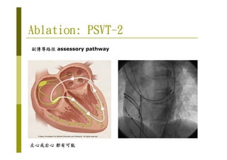 Ablation: PSVTAblation: PSVTAblation: PSVTAblation: PSVT----2222
副傳導路徑副傳導路徑副傳導路徑副傳導路徑 assessory pathway
左心或右心左心或右心左心或右心左心或右心 都有可能都有可能都有可能都有可能
 
