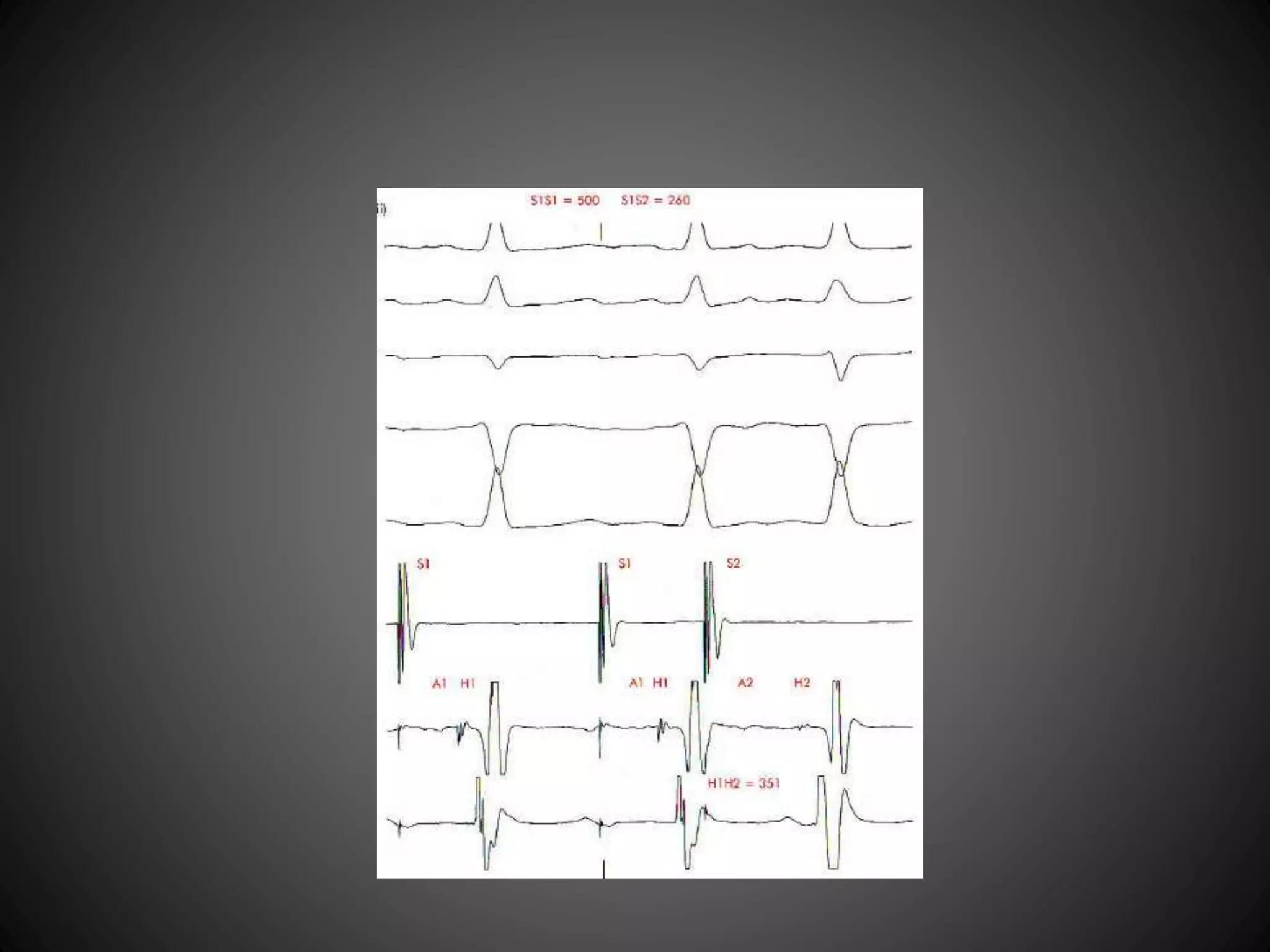 Ep Study Layout Electrophysiology study protocol | PPTX