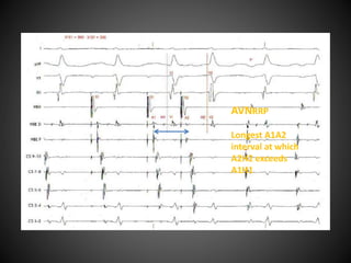 Electrophysiology study protocol | PPTX