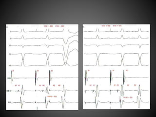 Electrophysiology study protocol | PPTX