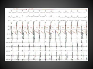Electrophysiology study protocol | PPTX