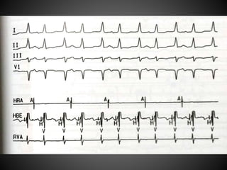 Electrophysiology AVNRT | PPTX