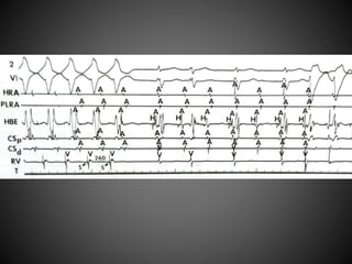 Electrophysiology AVNRT | PPTX