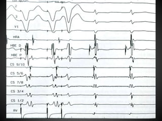 Electrophysiology AVNRT | PPTX